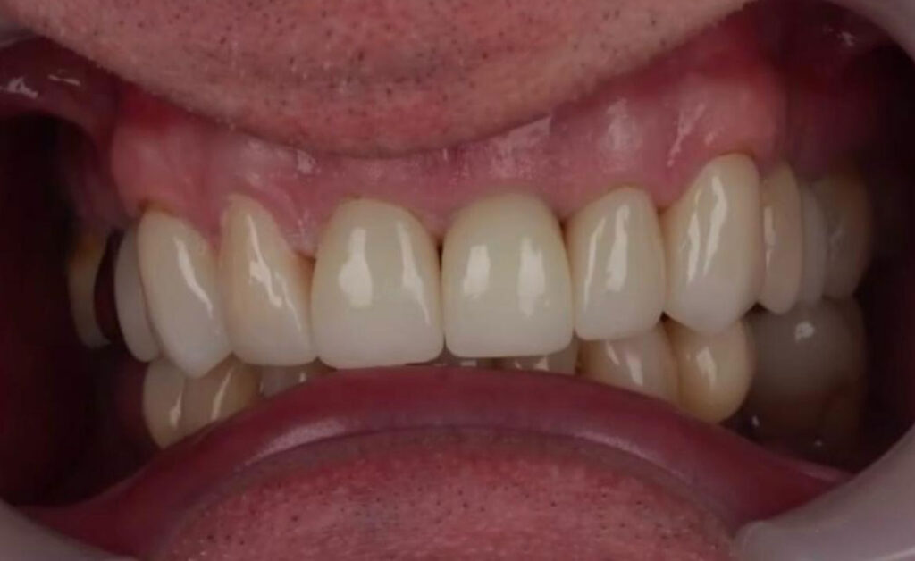 dental laboratory upper implant after 4