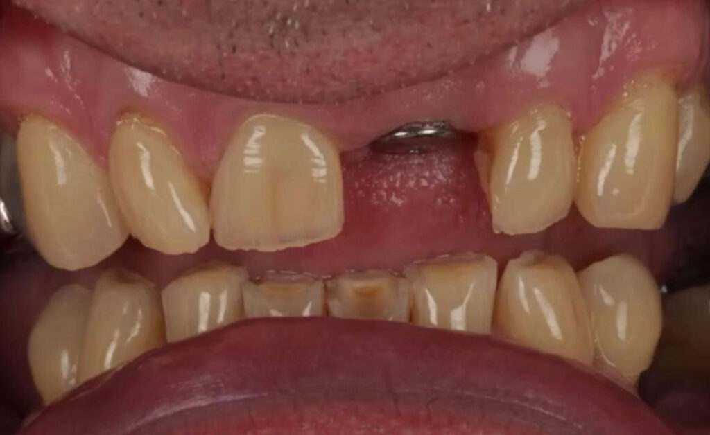 dental laboratory upper implant before 4