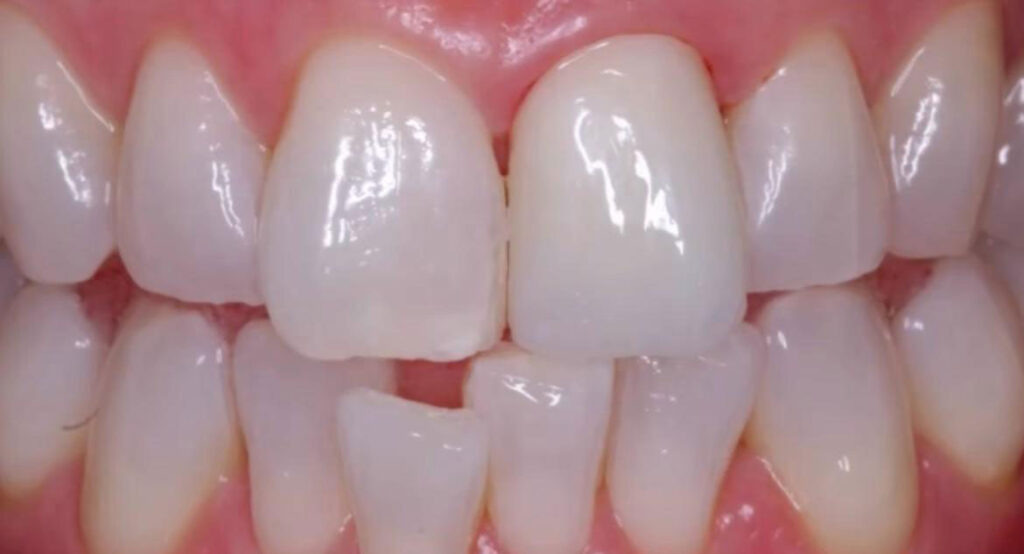 dental laboratory upper zirconia crown after 5