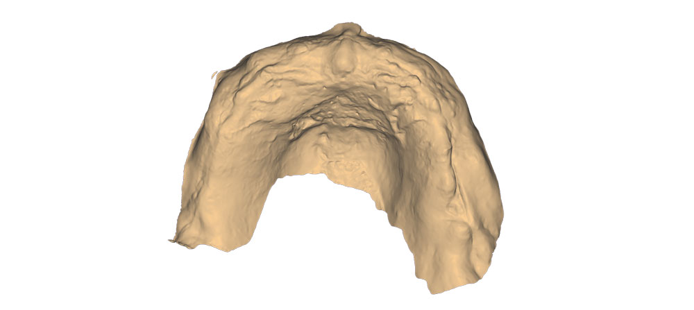 1 Primary impression scan