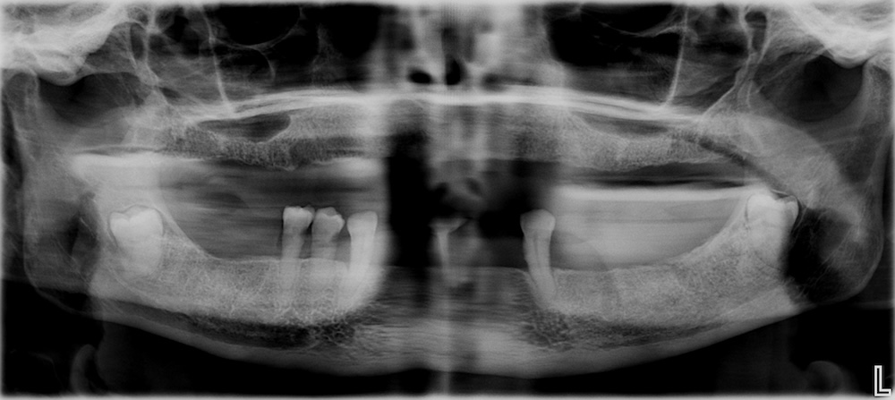 2 CBCT scan