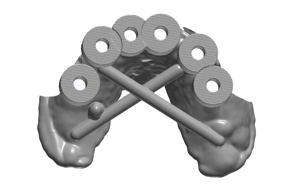 4 Upper surgical guide