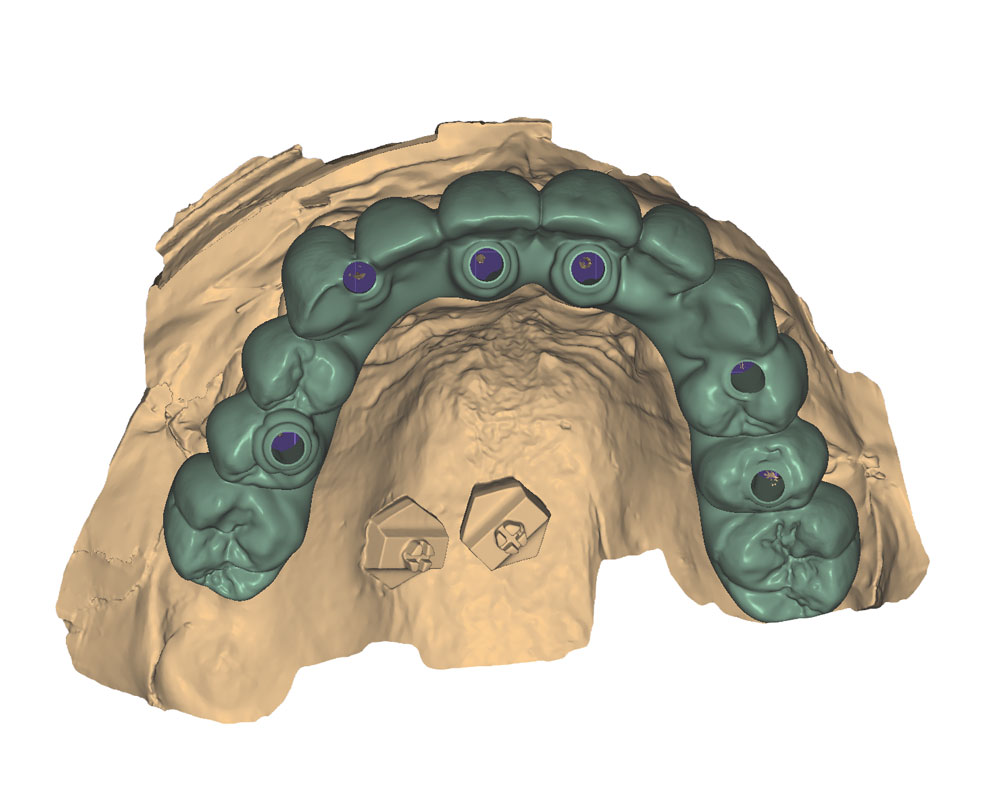 6 surgical guide