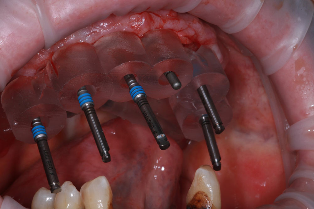 8 Surgical placement