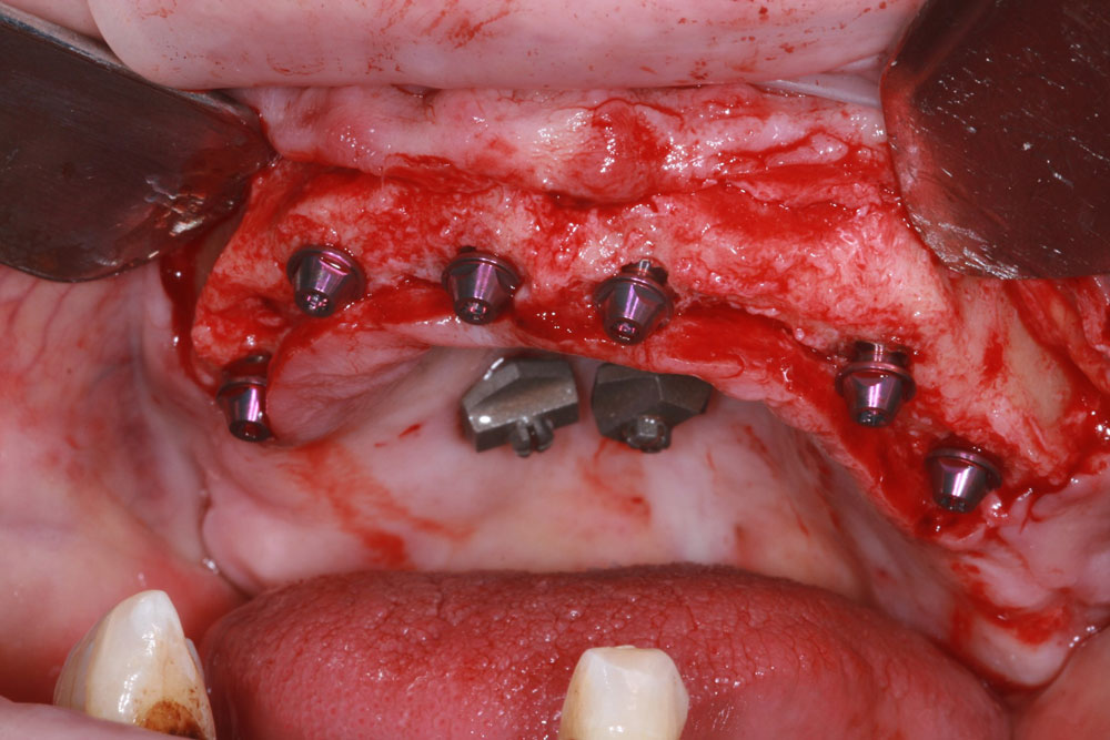 9 implants placed multi units added