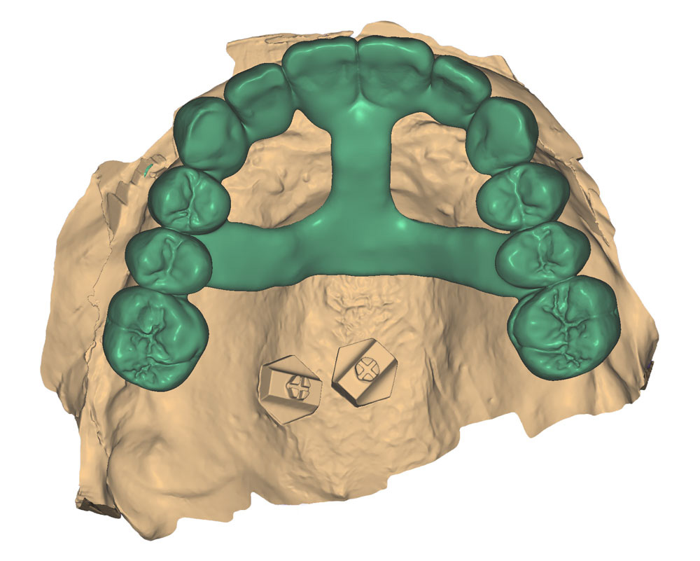dental lab prosthetic design.jog