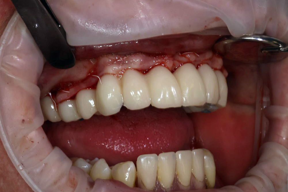 implant fit verification