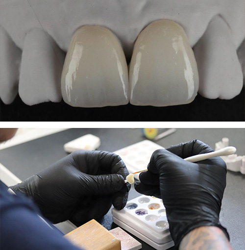 dental lab veneers