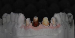 dental veneers dark teeth dental veneers dark teeth