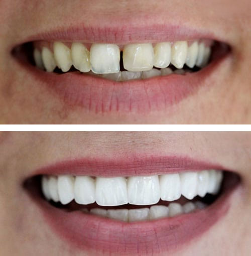 dental veneers example1