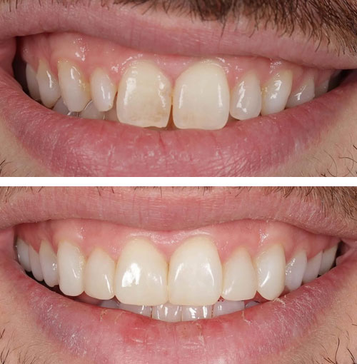 dental veneers example2