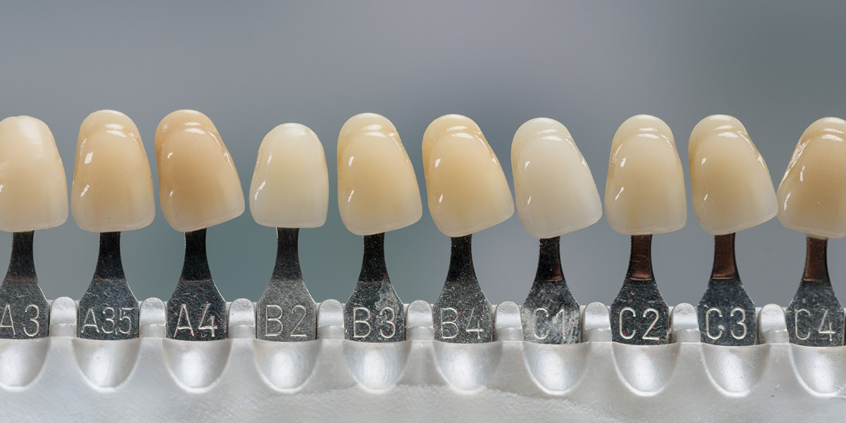 veneer preparation mistakes