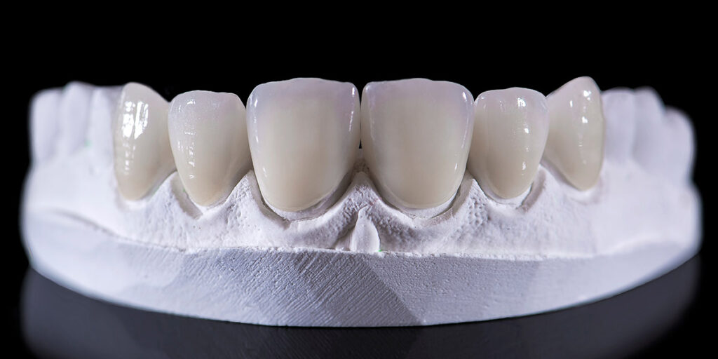 Model of teeth with bulky veneers