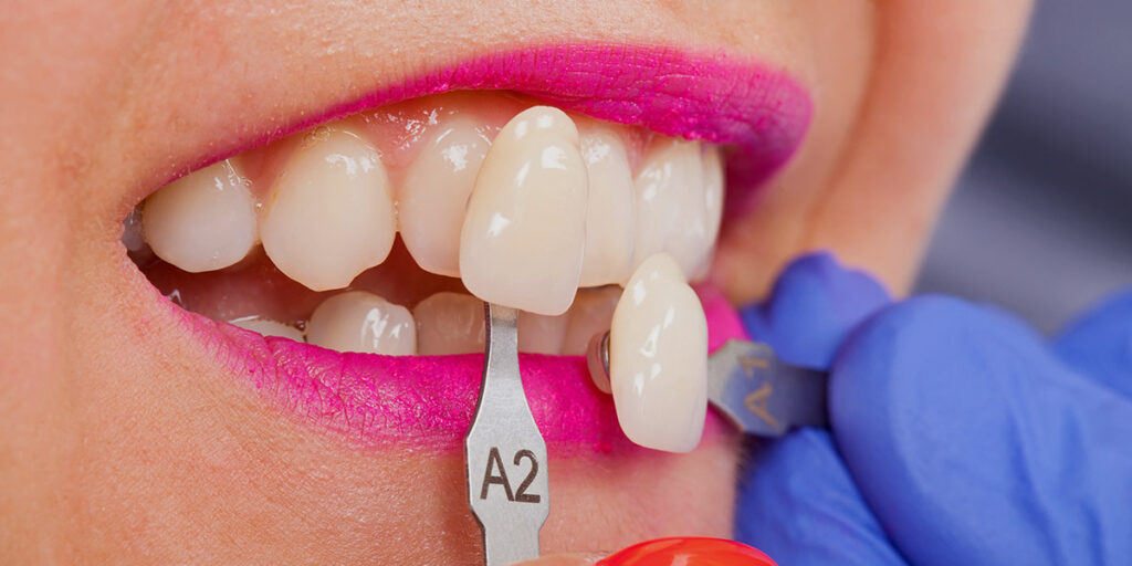 womans teeth with dentist for veneer shade matching