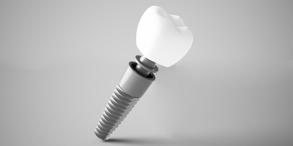 Dental implant render implant case planning