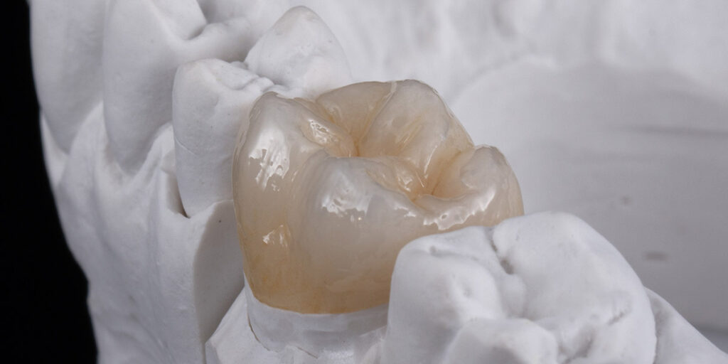 Dental lab dental crown remakes and dental crown on model