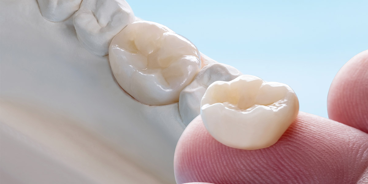 dental crown remakes