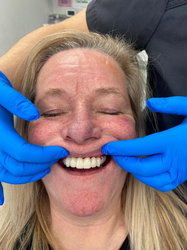all on x full arch patient outcome