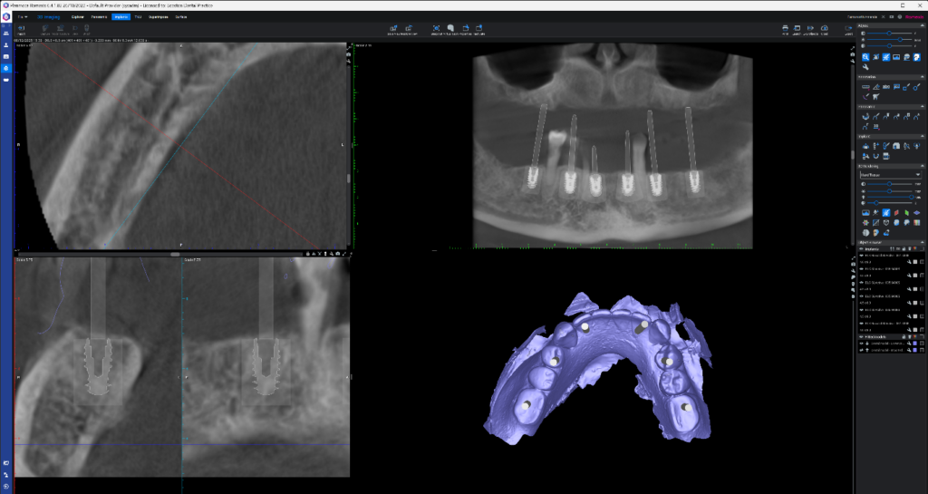 all on x lower implant planning