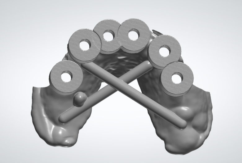 all on x lower surgical guide