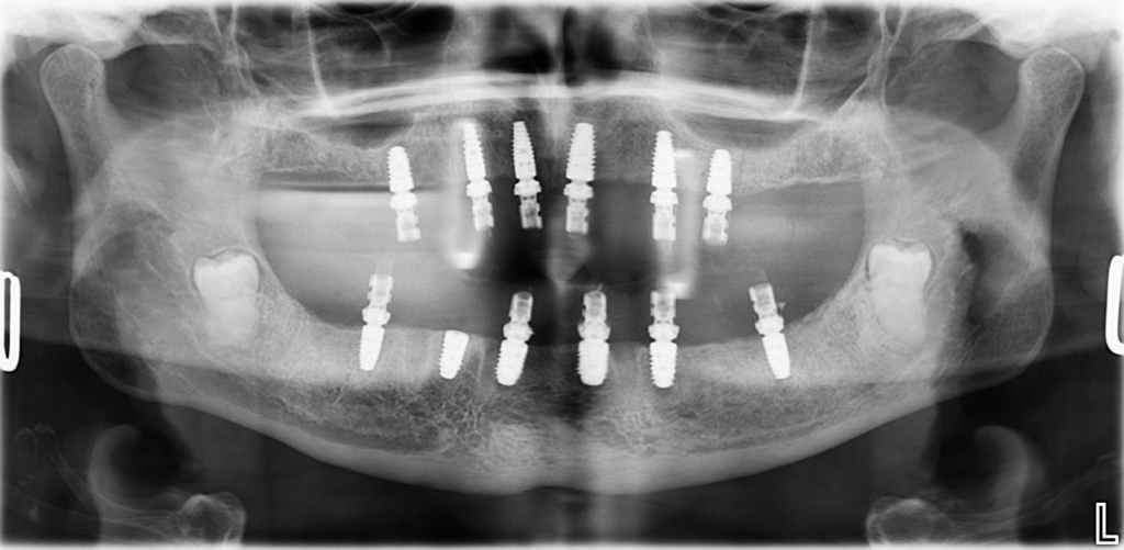 all on x placed implants cbct