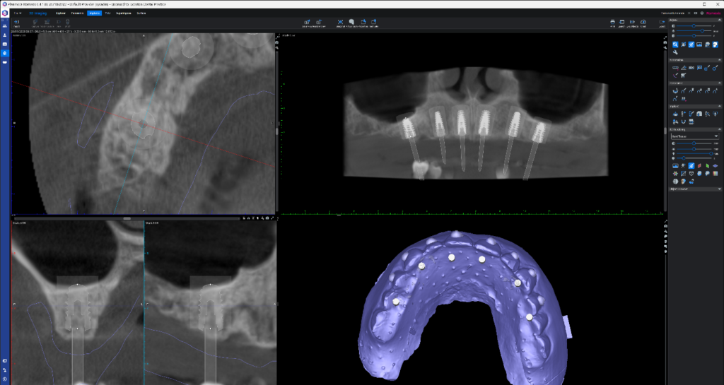all on x upper implant planning