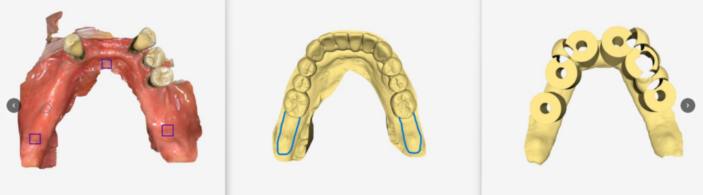 all on x upper surgical guide