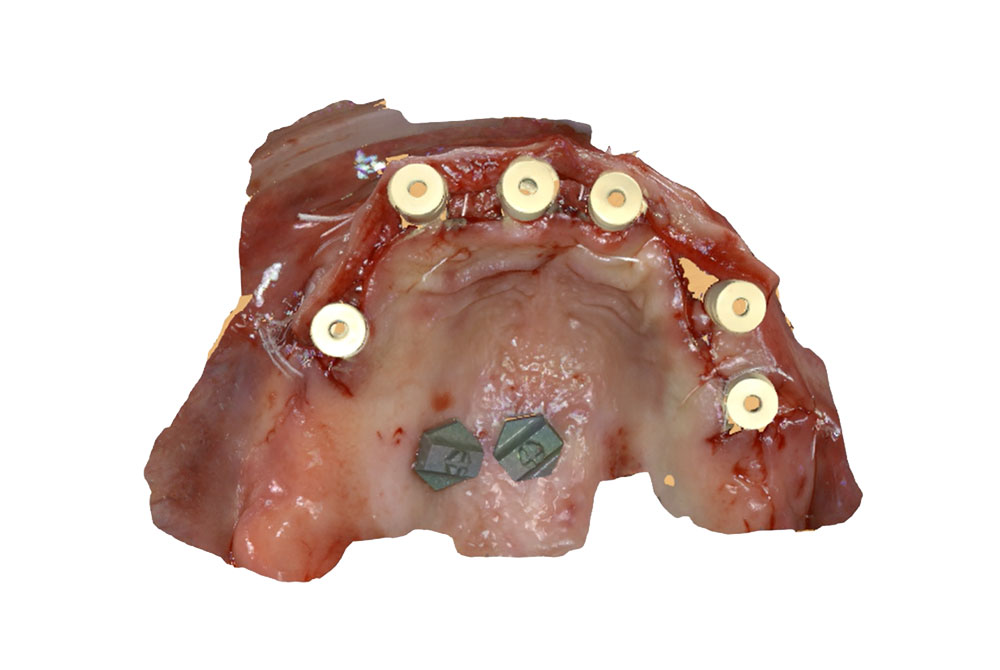 case study upper with scanbody and markers