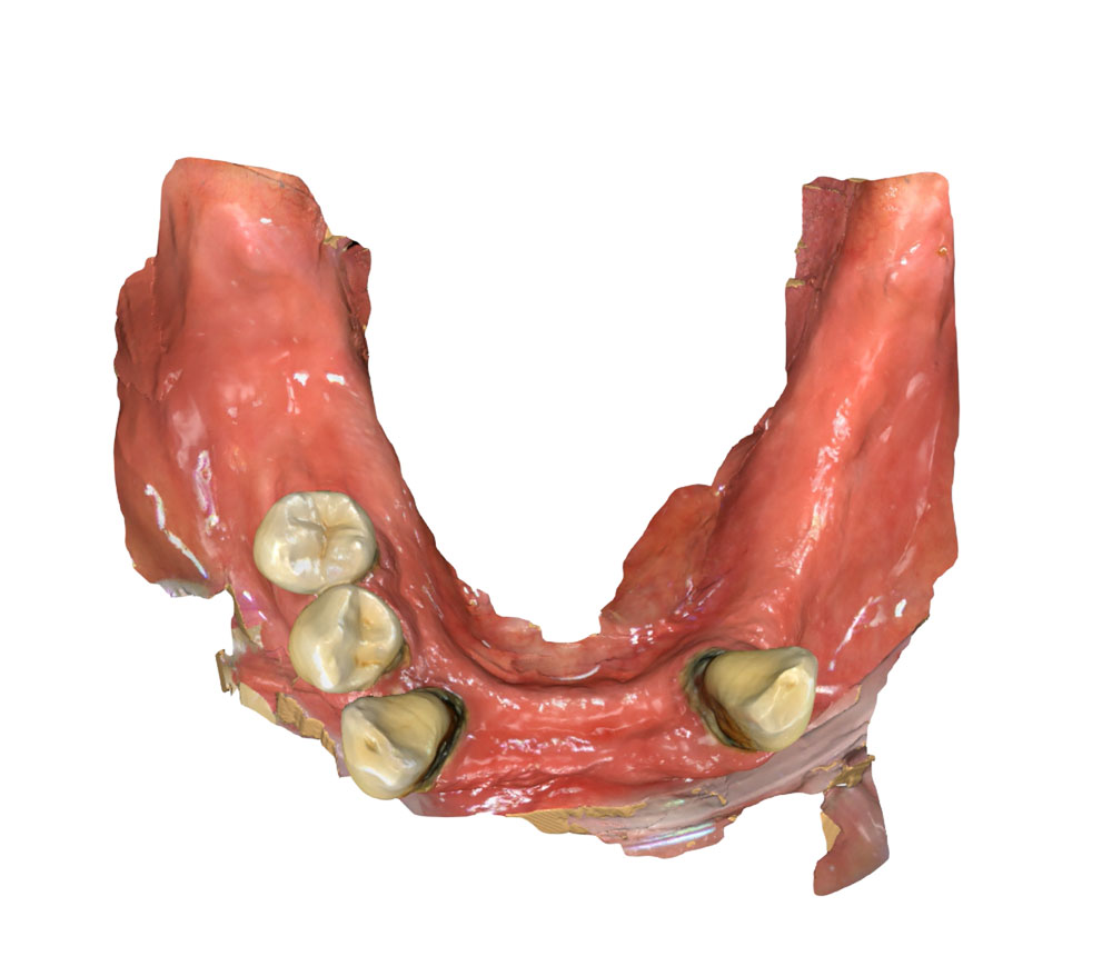 dental lab planning lower scan