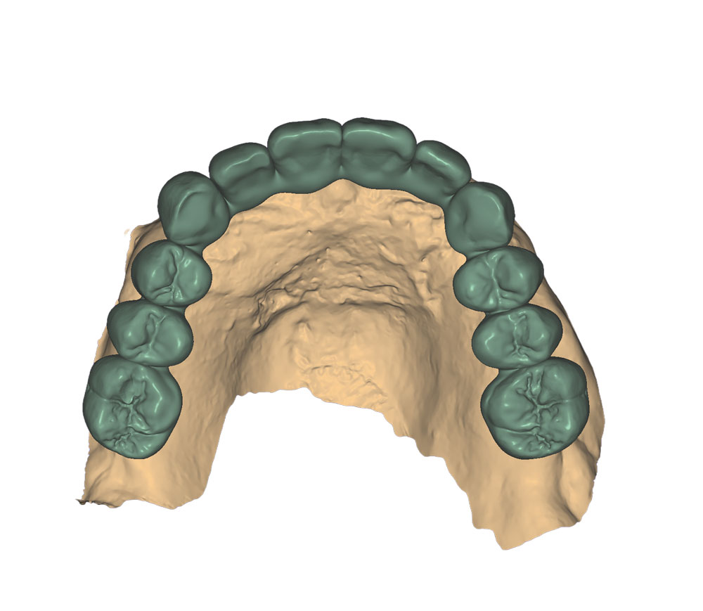 implant diagnostic digital wax up palatal