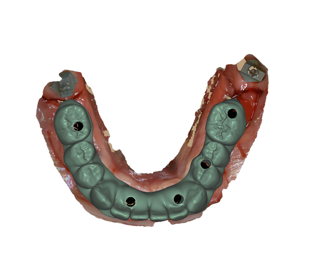 implant imported wax up overlay lower