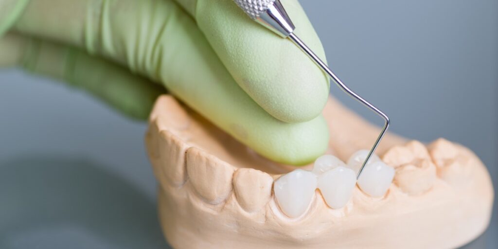 Dentist preparing a tooth for a crown and crown preparation