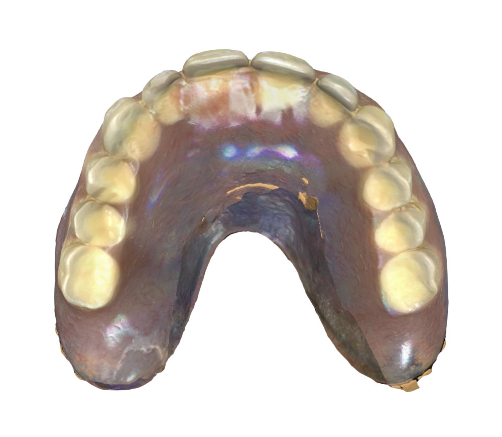 all on x original denture