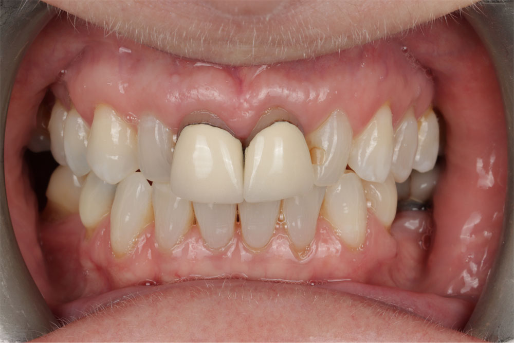Existing upper central crowns before aesthetic restorative treatment