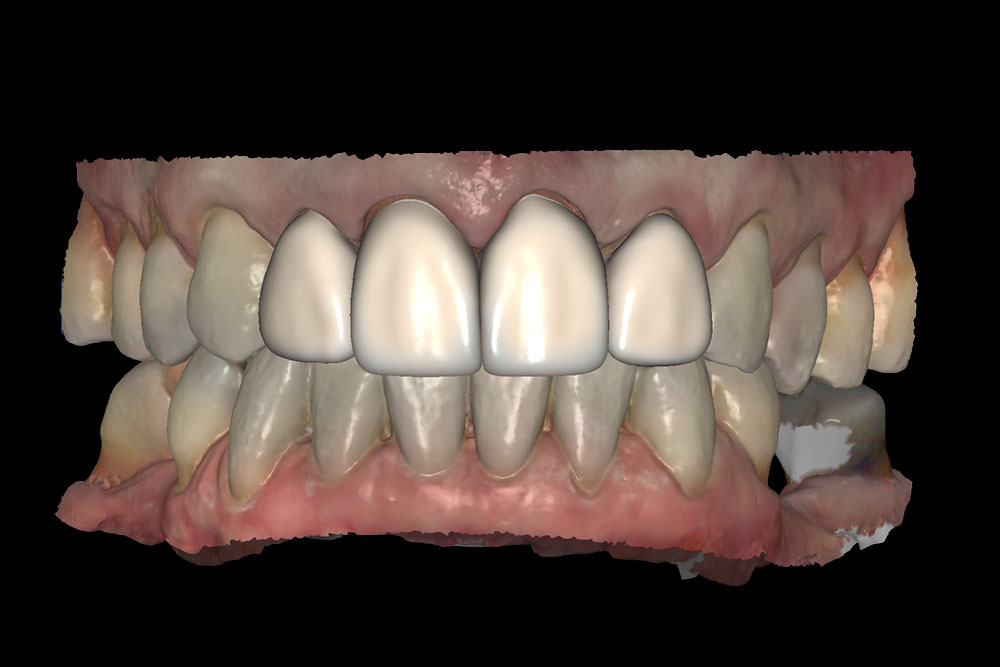 Exocad digital smile design showing proposed central crowns and lateral veneers
