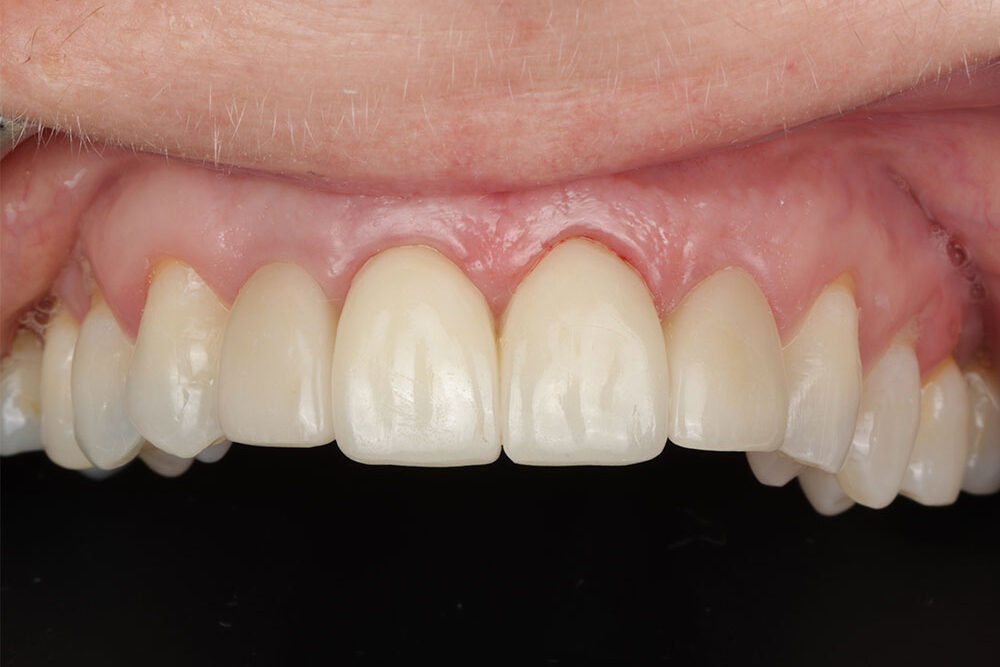 Completed zirconia crowns and E.max veneers restoring the patient's upper front teeth